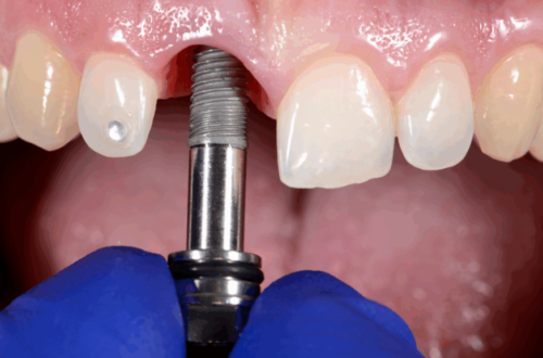 Implant w strefie estetycznej