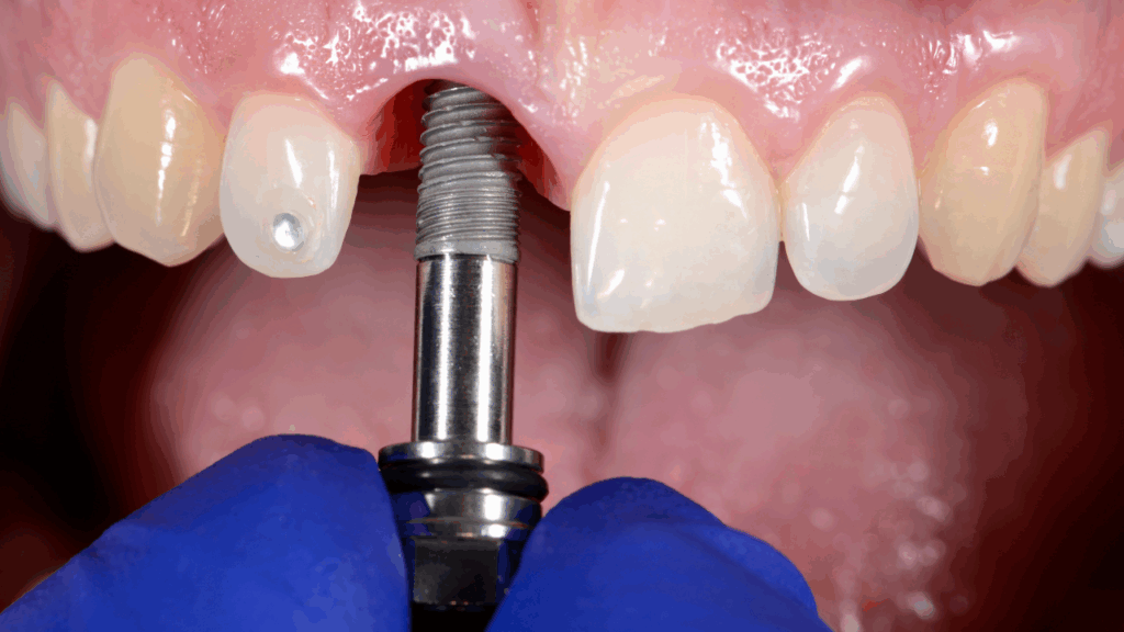 Implant w strefie estetycznej